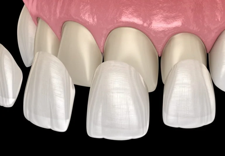 Zirconium Veneers